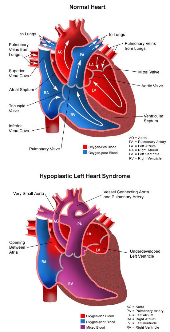 健康・医学 Hypoplastic Left Heart Syndrome Hypoplastic Left Heart Syndrome (HLHS): Causes, Symptoms
