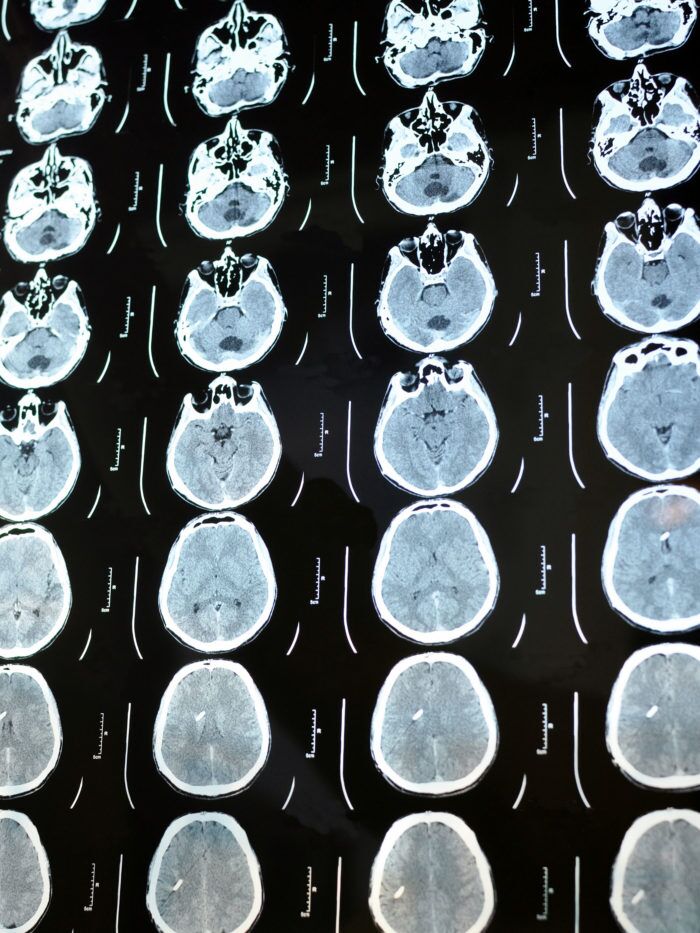 Computed tomography image scan of the brain. CT film of a human skull and brain with intracranial shunt. Neurology background. Medicine, science, vertical view.