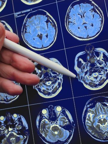 CHOC leads 21-center study to find predictive biomarkers for infantile spasms, a rare and dangerous type of epileptic seizure