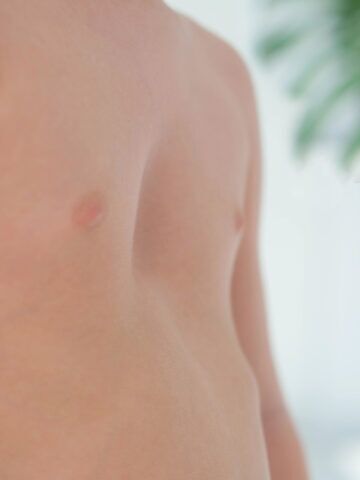 "Sunken chest" - Pectus Excavatum procedures for