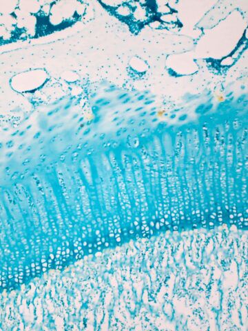 FDA approval grows use of growth therapy for children with achondroplasia 