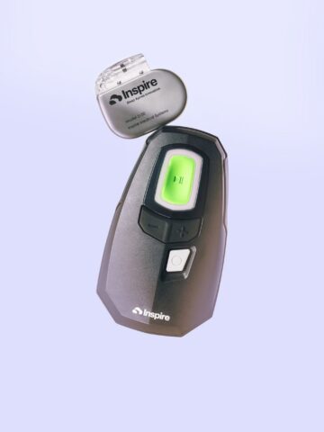 Inspire device for sleep apnea