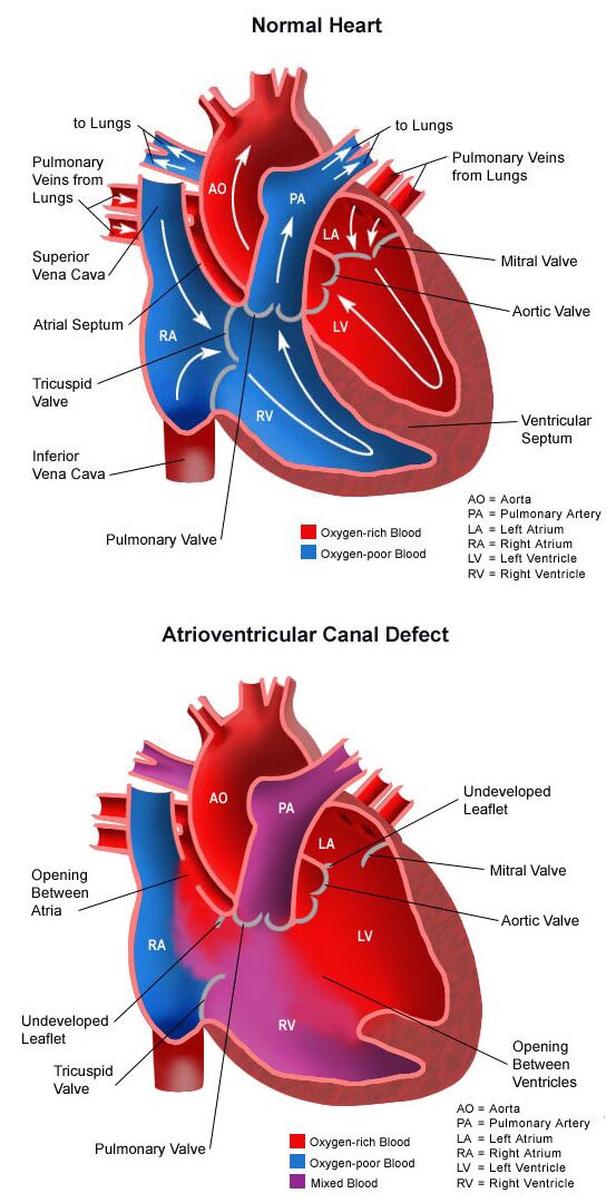 Atrioventricular Canal Defect Vertical