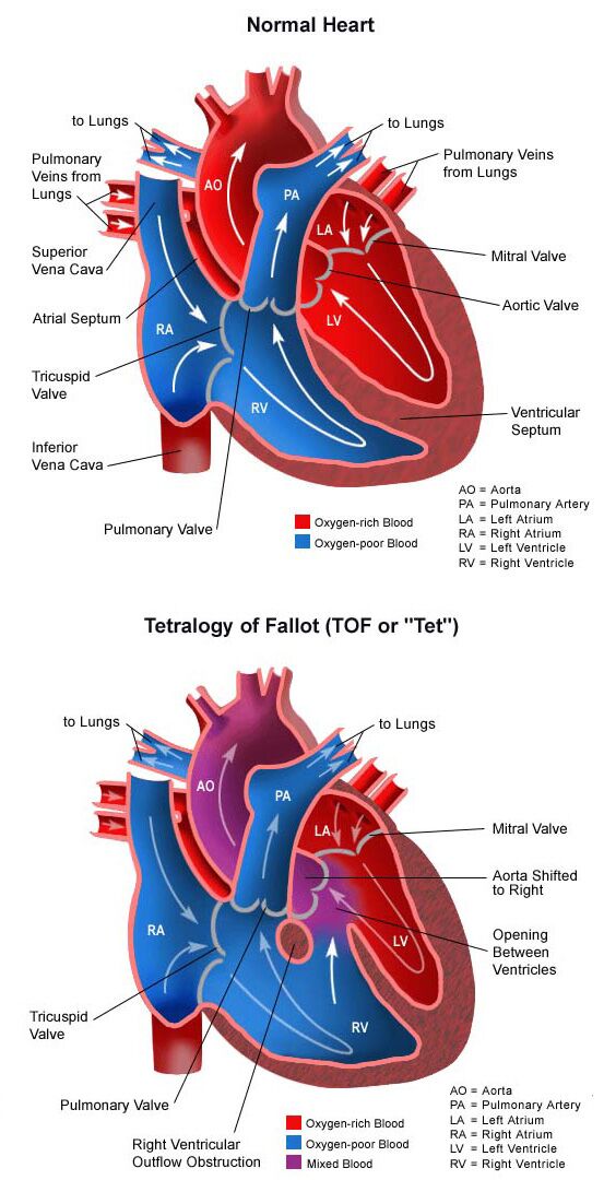 Diagram of a heart with tetralogy of Fallot Vertical