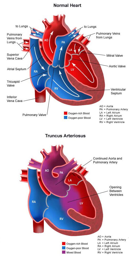 Truncus Asteriosus Vertical