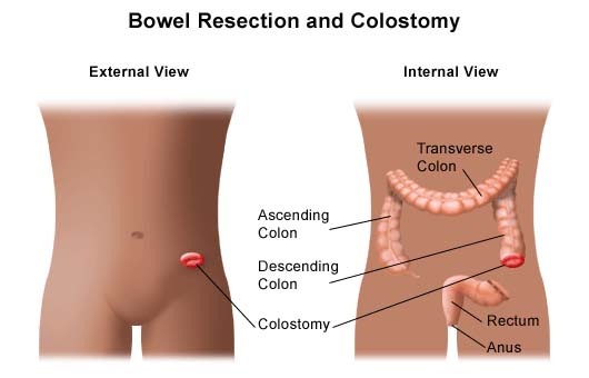 Diagram showing a bowel resection and colostomy procedure