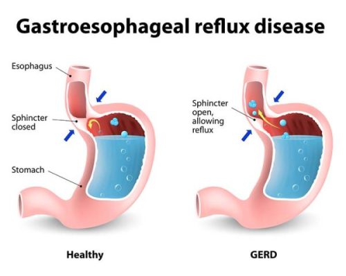 Diagram showing healthy stomach vs. stomach with GERD