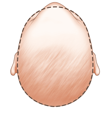 baby head shape metopic synostosis