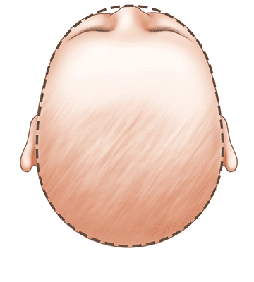 baby head shape coronal synostosis