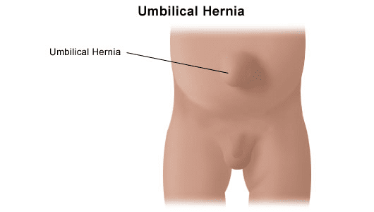 umbilical hernia