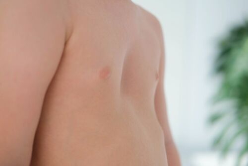 image of child with pectus excavatum