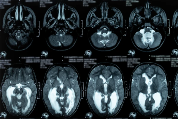 MRI scan of brain with obstructive triventricular hydrocephalus