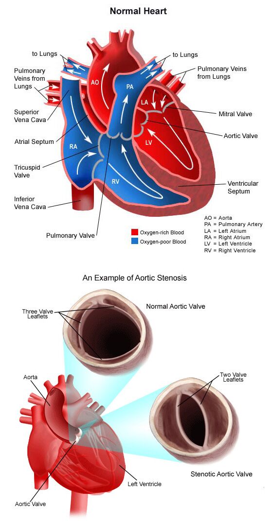 Aortic Stenosis