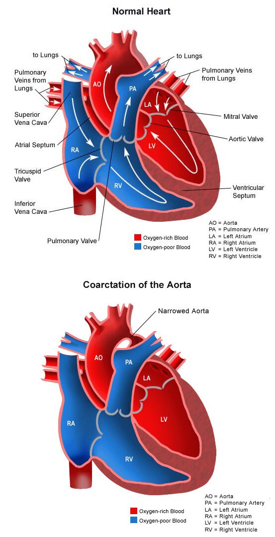 Coarctation of the Aorta