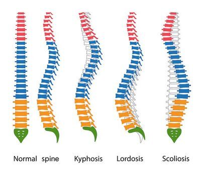 Diagram showing different types of spinal deformities